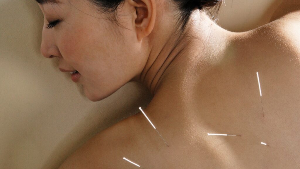 How Does Acupuncture Work to Relieve Pain?